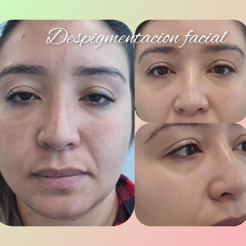 antes y después de rejuvenecimiento facial en bogotá