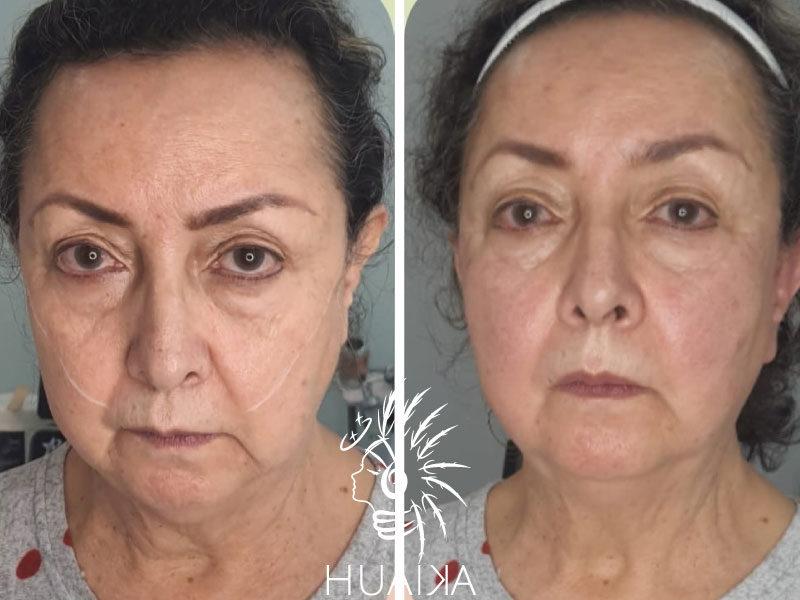 antes y después de rejuvenecimiento facial