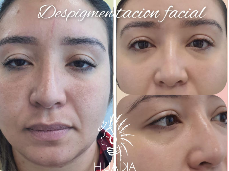 antes y después de rejuvenecimiento facial