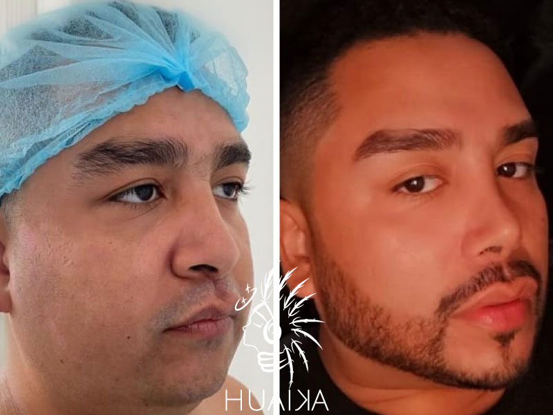 antes y despés de rinomodelación con ácido hialuronico